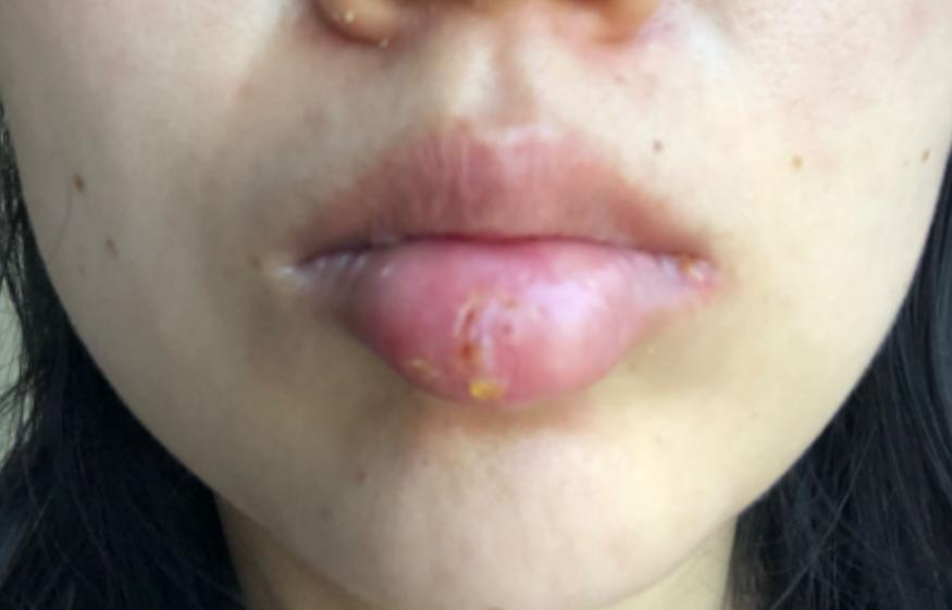 粉丝反馈：，每天不到2毛钱，搞定了多年的上热下寒，连痘痘都没有了[给力][给力]