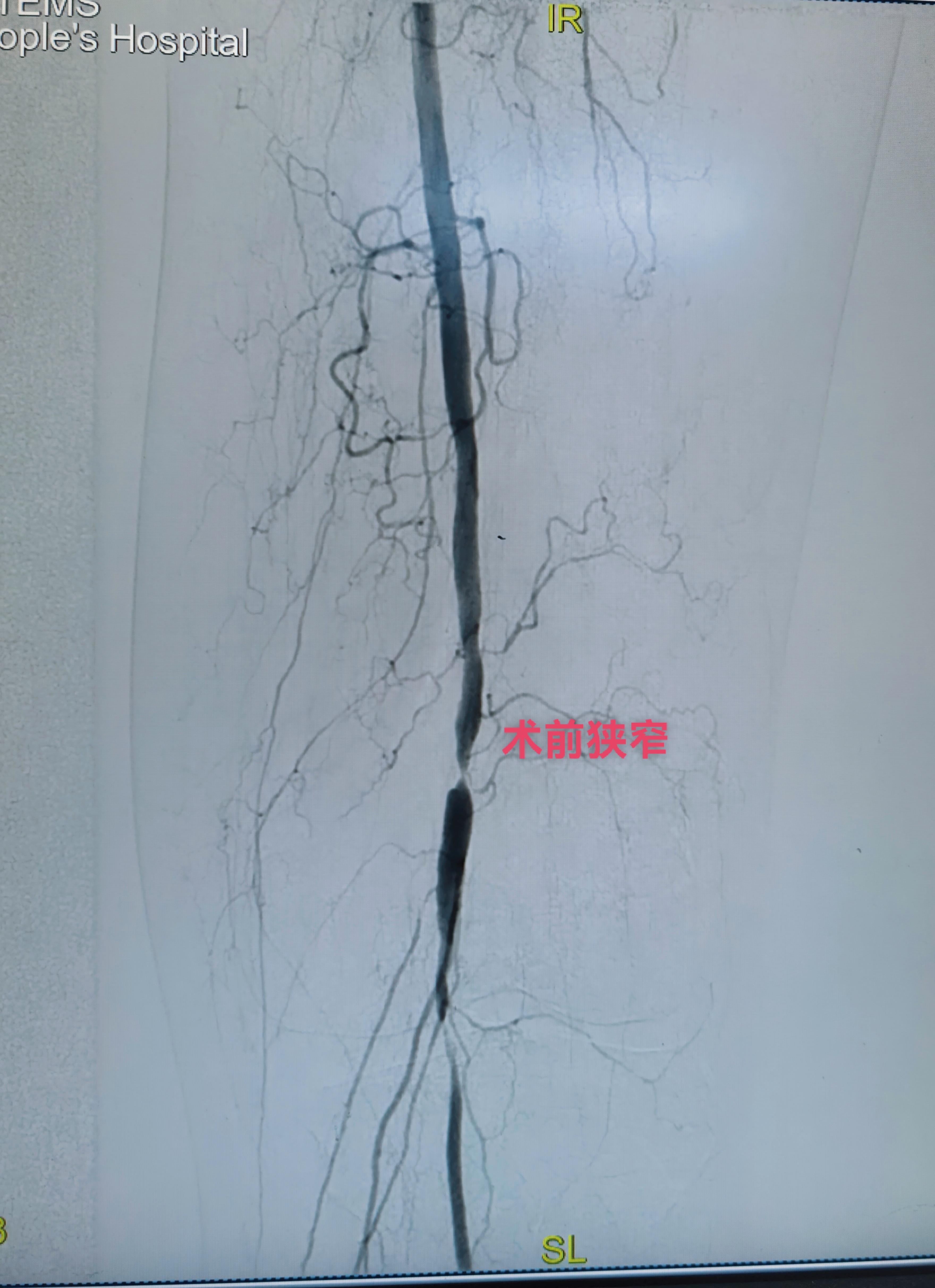 下午第一台糖尿病足三次腔内治疗再次未规律服药再次狭窄闭塞，下肢溃烂发黑...