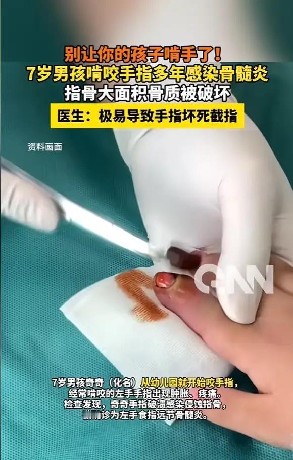 湖南，一男孩喜欢咬手指，他的妈妈尝试过各种方法都没能改掉他这个习惯，久而久之也就