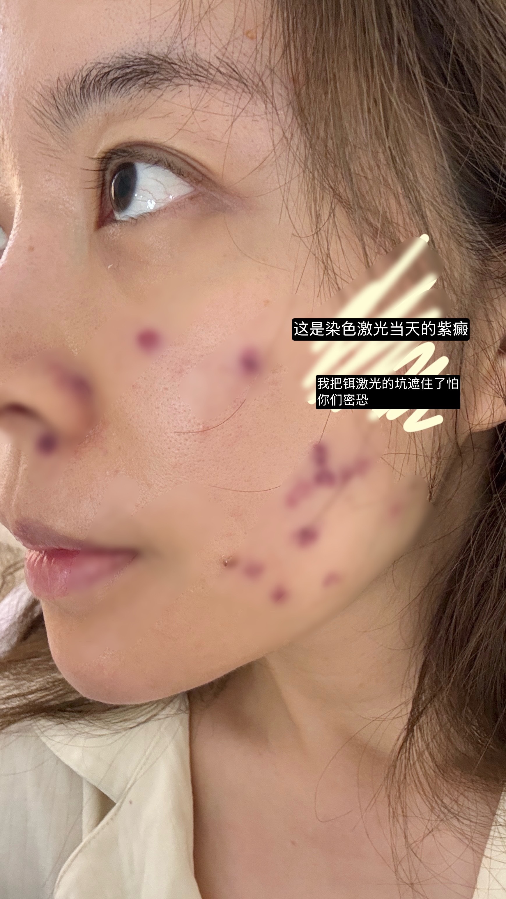 虽然有点不想把这么丑的图留在网上，但是我决定还是给你们看一下打完染料激光后的样子