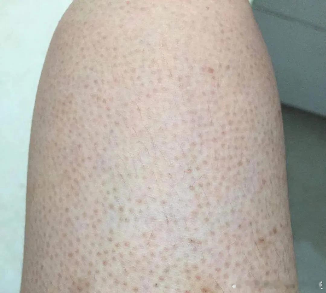 又到了穿短袖短裤的季节，小红却开心不起来，手臂和腿上的鸡皮肤非常嚣张，粗糙、暗沉