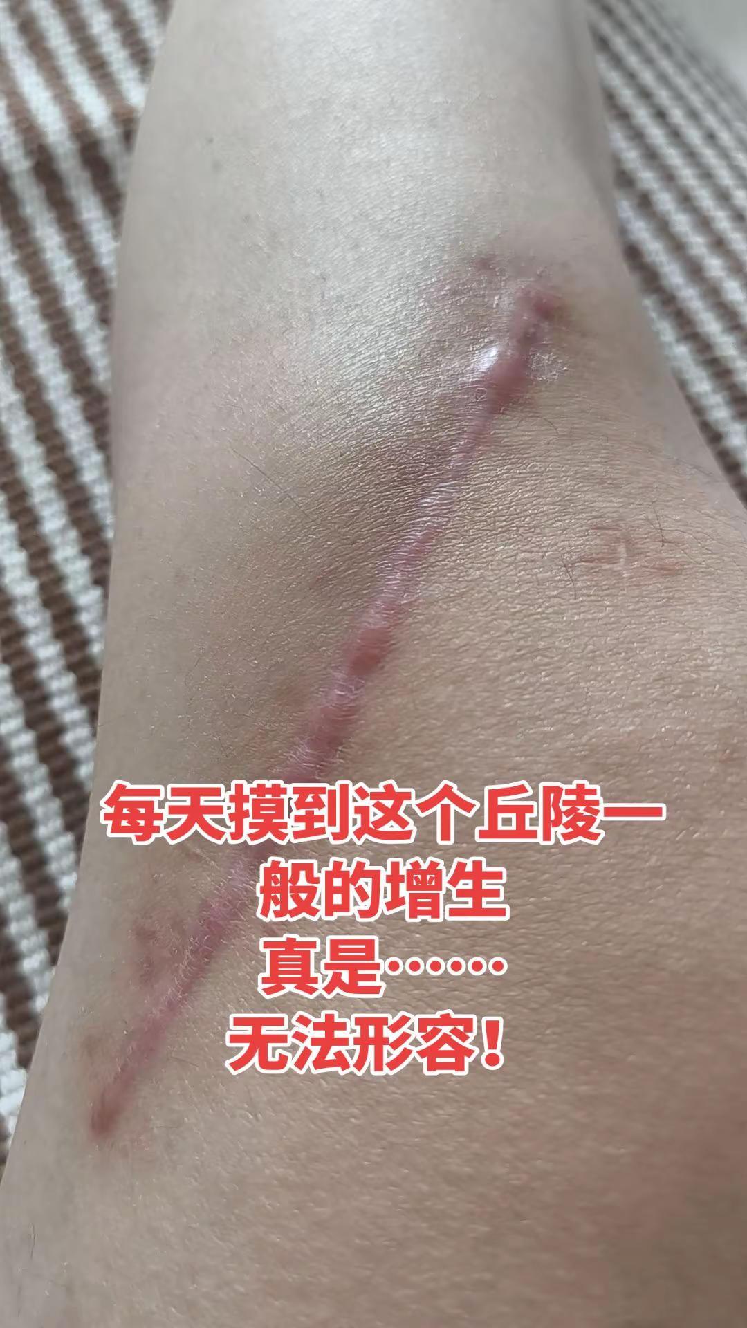 膝盖疤痕怎么护理