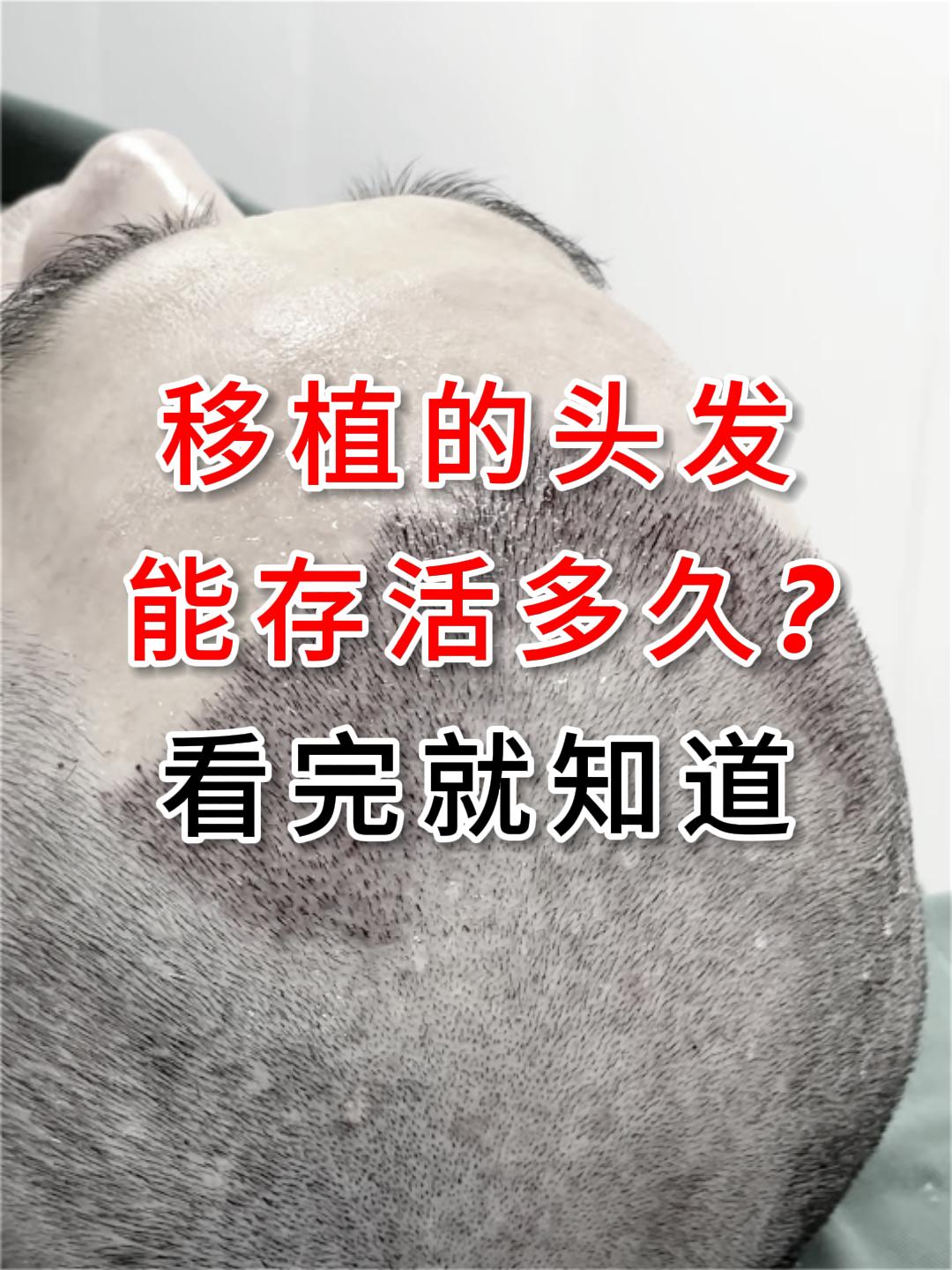 移植的头发能活多久？。