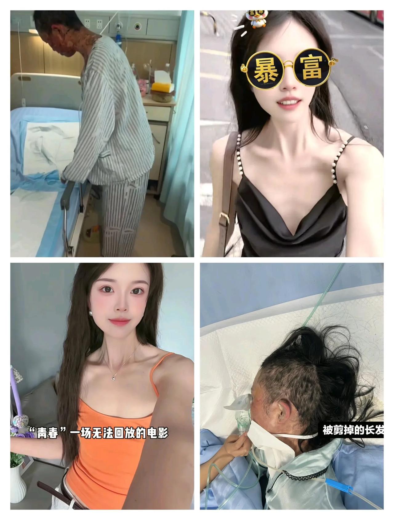 头孢过敏有多严重？
后果简直不敢想象，
浙江赵女士因为头孢过全身长水泡，甚至差点