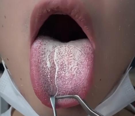 白白厚厚的舌苔，抓紧解决！别再犹豫了
拖得越久，烦恼越重，一般会导致口苦口臭
欲