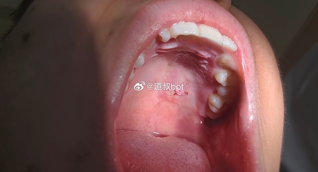 尖锐湿疣，第一次看到在嘴巴里的。 ​​​