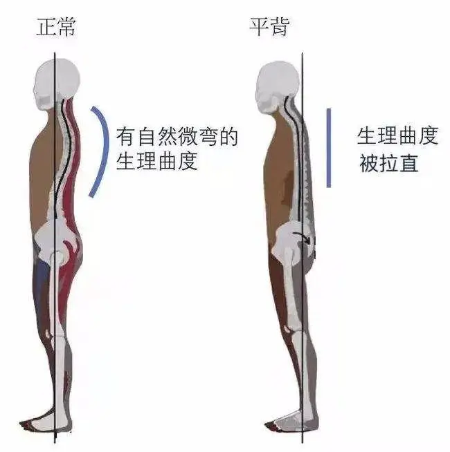 不良身体曲线的代偿模式