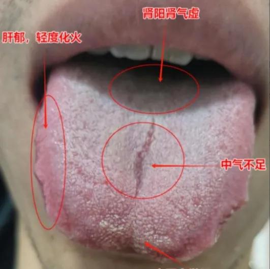 舌苔白腻，两边鼓胀，为啥疏肝解郁、补肾升阳没有用？原来是因为中气虚！
 
患者性