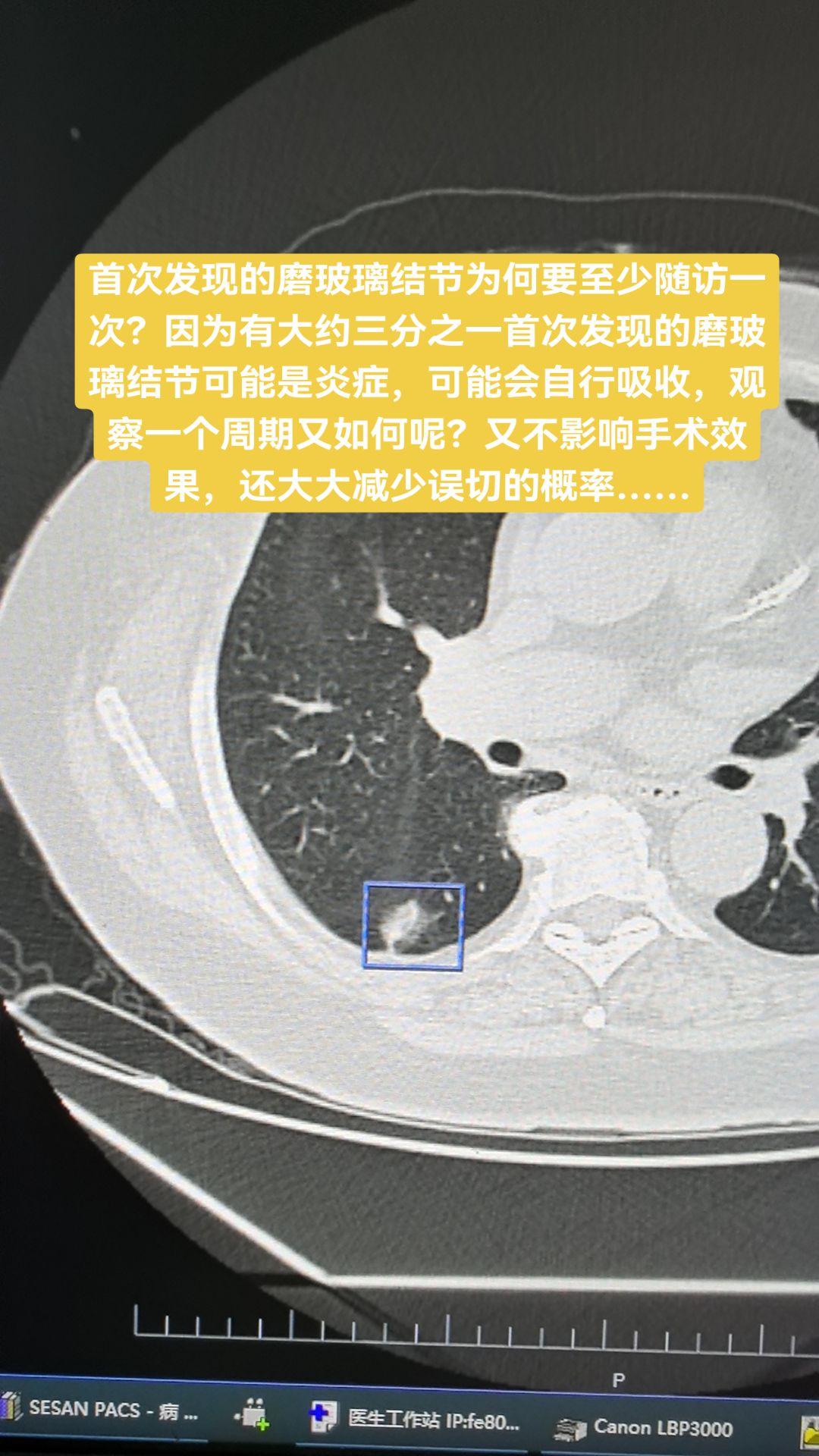 首次发现的磨玻璃结节为何要至少随访一次？因为有大约三分之一首次发现的磨...