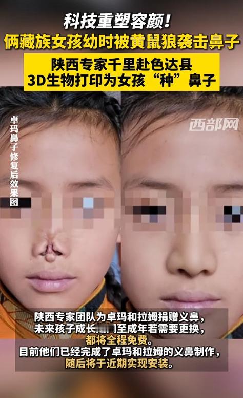 “这才是真专家！”四川甘孜，两名藏族女孩小时候睡觉时，意外被黄鼠狼咬下了鼻子，造