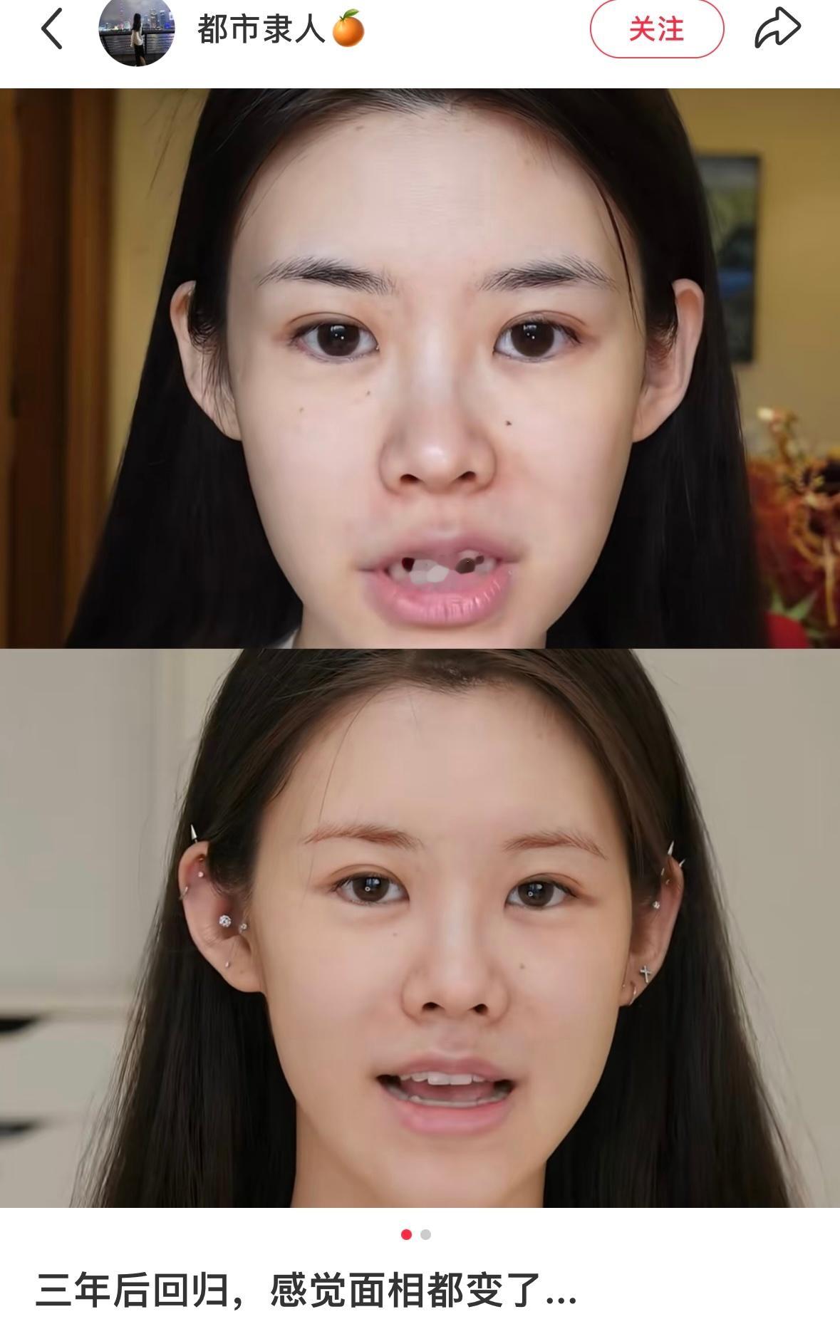 她是真的很会化妆很少动建模。这三年竟然没大动鼻子，鼻小柱（海鸥线）变凹了，鼻基底