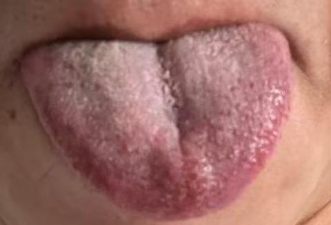 畏寒肢冷伴随心绪烦躁，多为阳虚致精关失固






近期有位年轻粉丝前来咨询，