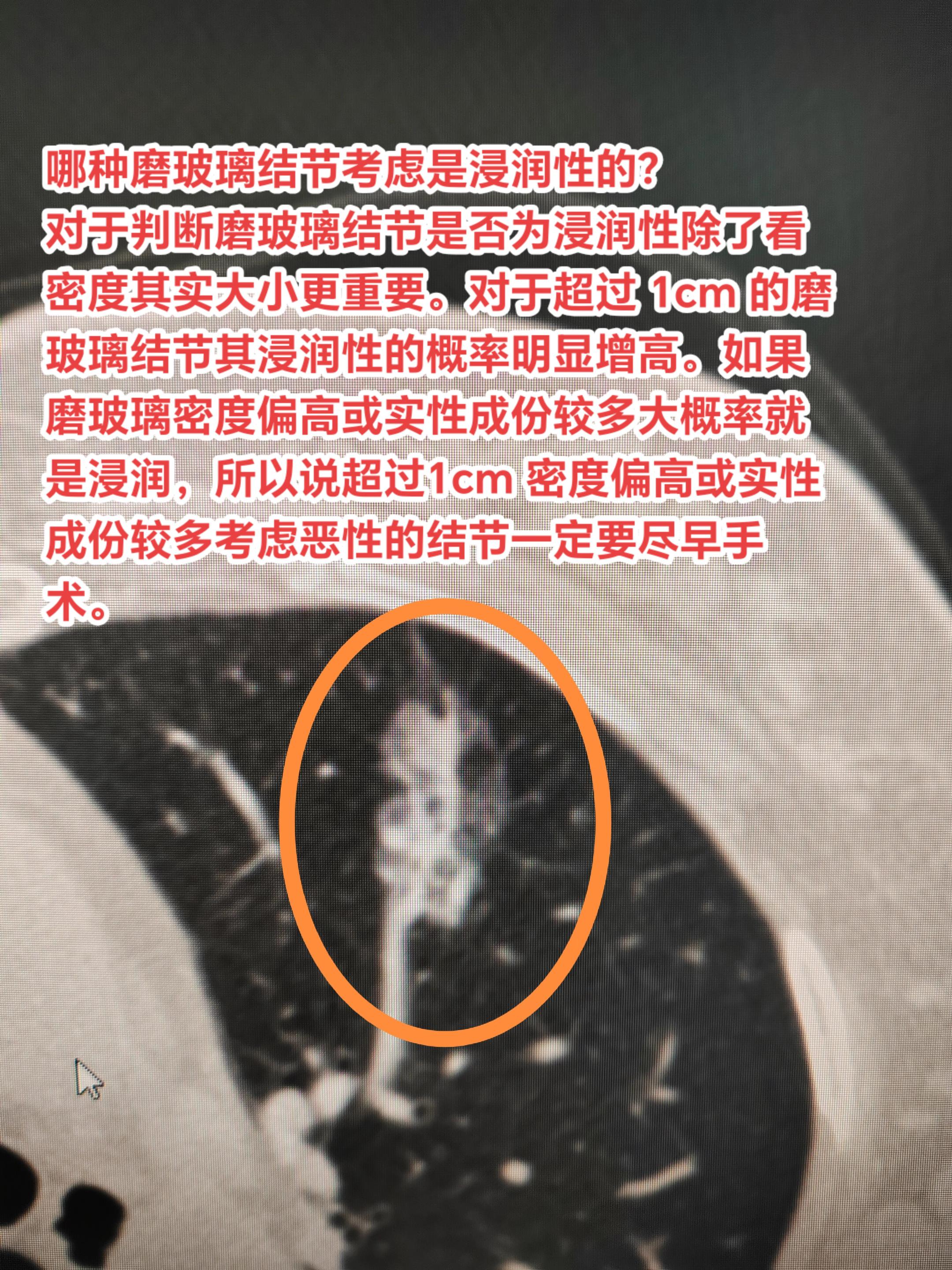 哪种磨玻璃结节考虑是浸润性的？对于判断磨玻璃结节是否为浸润性除了看密度...