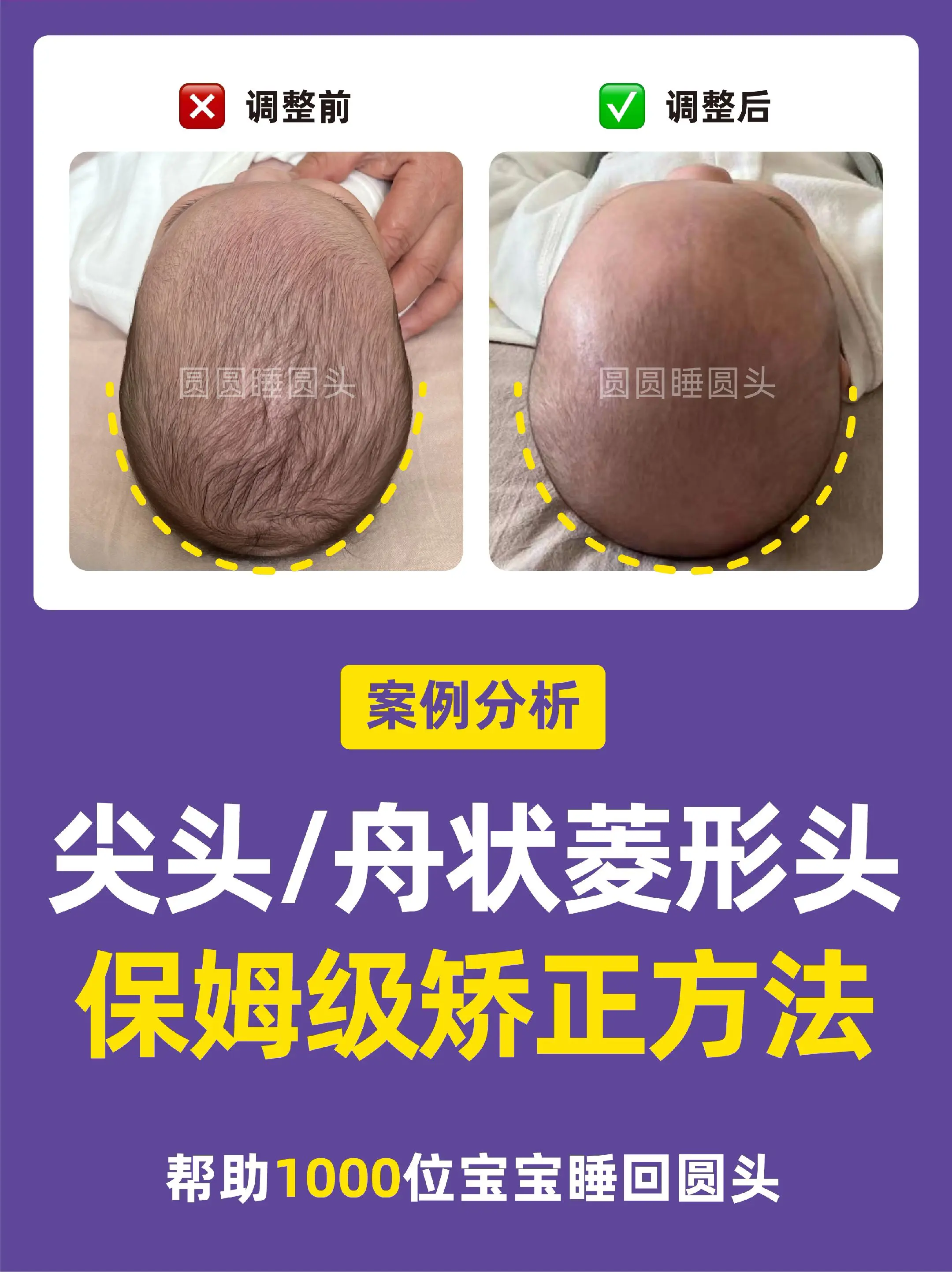 宝宝头型|长尖头➕菱形头睡圆头教程。