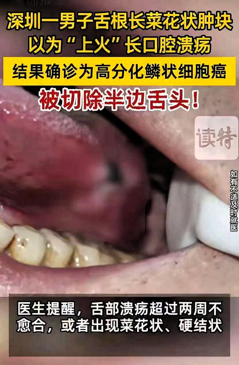 深圳41岁的陈先生舌头长了个菜花状肿块，又硬又凸，他以为是上火长溃疡，没当回事。