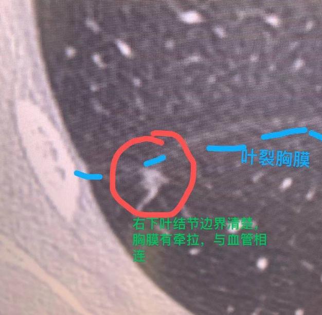 这位33岁的女性患者，体检发现右肺有2个磨玻璃结节，可以清楚地看到，这两个结节与