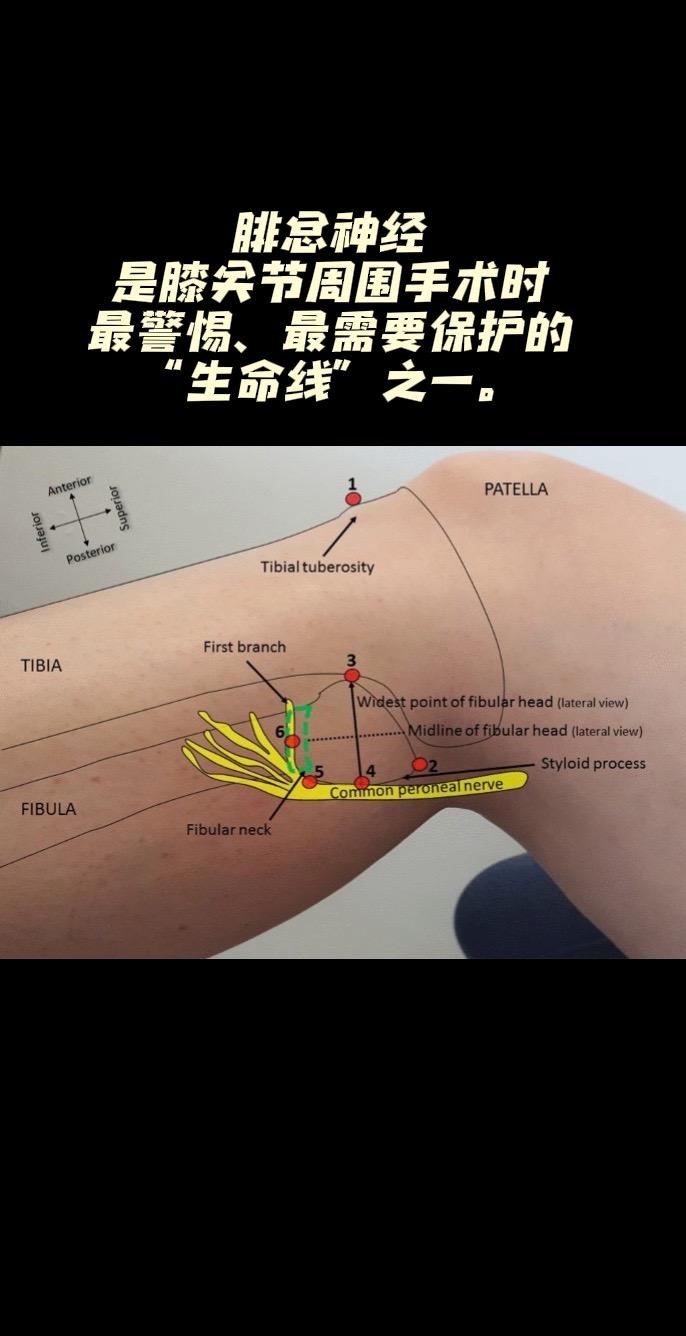 【警惕】膝关节手术中的“隐形雷区”腓总神经因其特殊的解剖走行结构和支配...