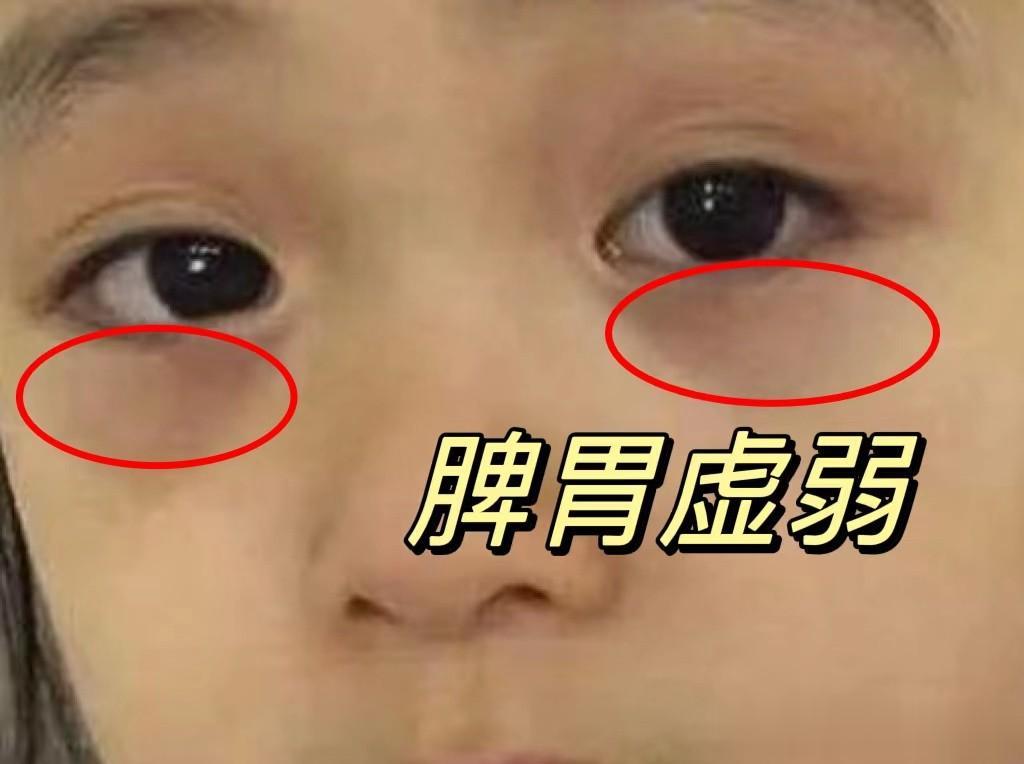 昨天面诊了这么一个孩子，一眼判断孩子脾虚，家长们可以关注一下！
 
欣欣（化名）