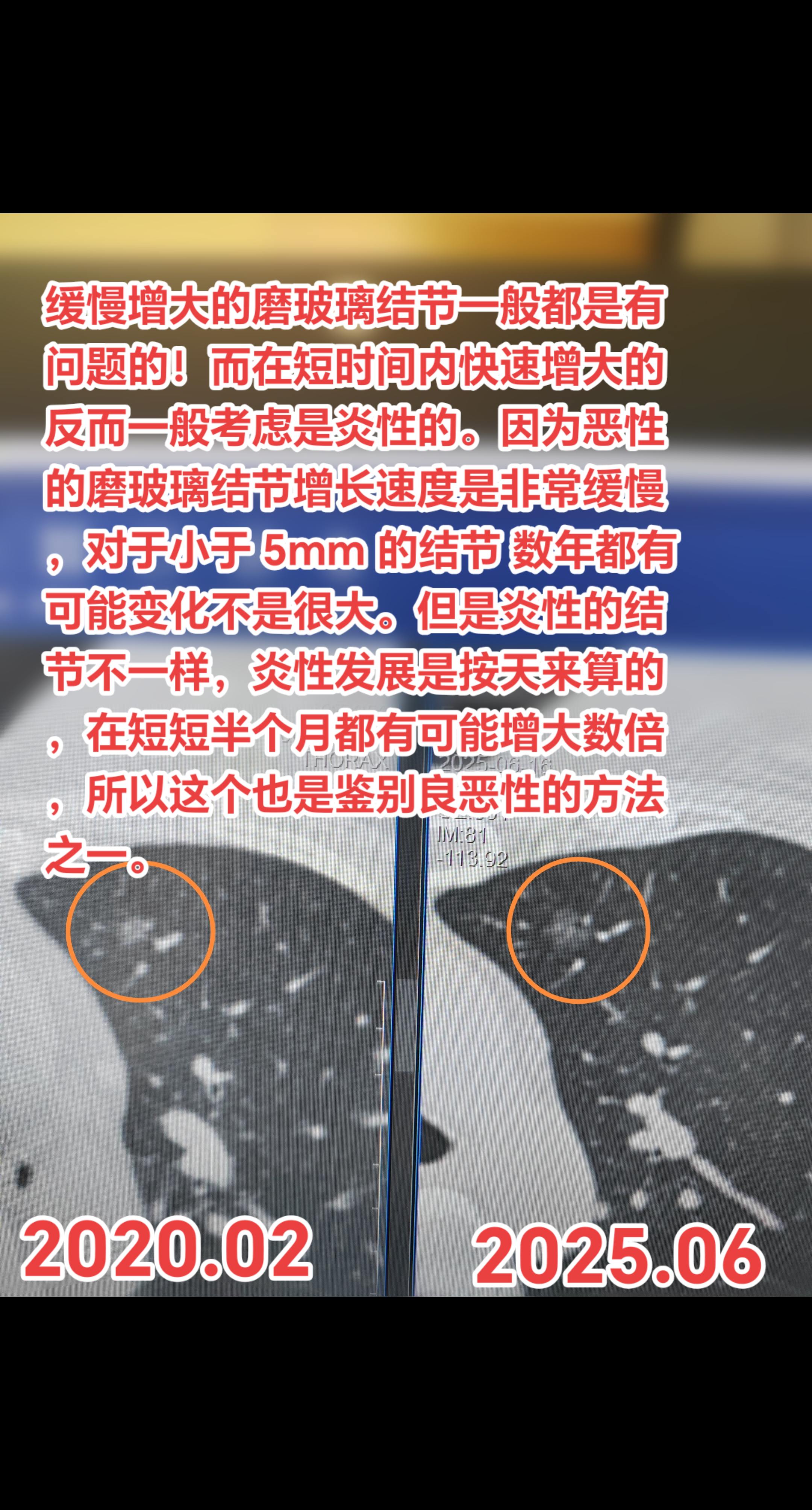 磨玻璃结节是良还是恶？缓慢增大的磨玻璃结节一般都是有问题的！而在短时间...