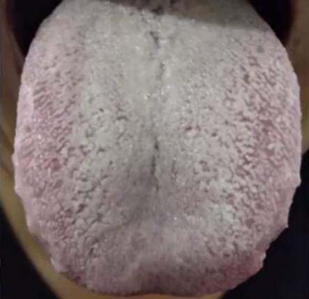只要几块钱的藿香正气，竟是调理厚腻苔的利器！

你看这个白腻苔，舌面上就像是下了