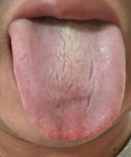 阳气亏虚兼虚火内扰，以致精关失于固摄






有粉丝留言，早年耗损时间较久，