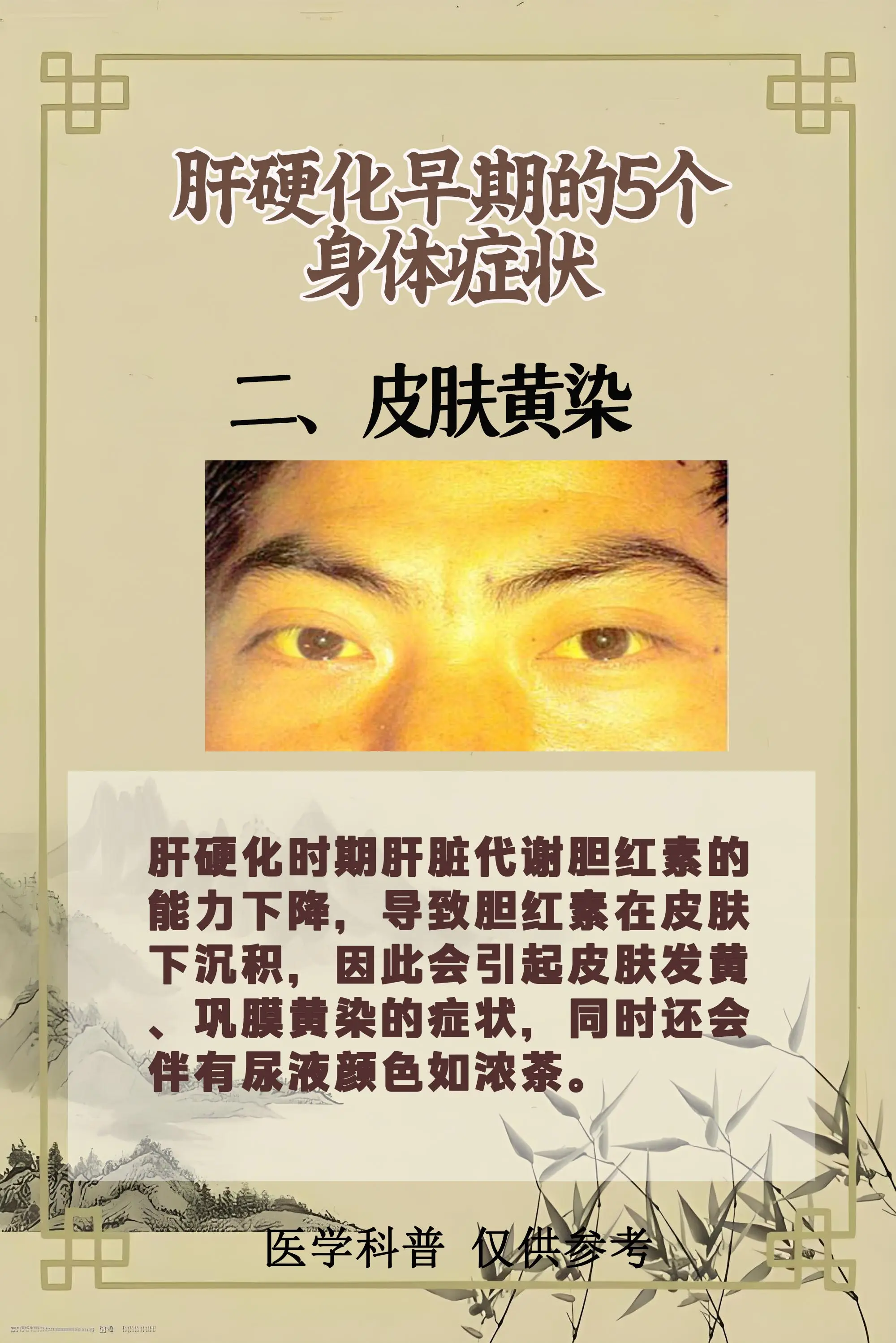 肝硬化 医学科普 山东 肝病
