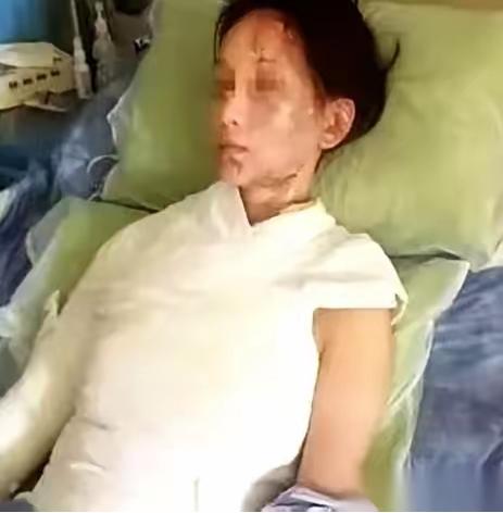 谁能想到，一顿普普通通的火锅，最后竟让一名女顾客全身四分之一被烫伤，也让一个17