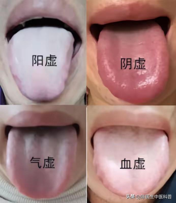 伸出舌头一看便知：你是气虚、血虚、阴虚、阳虚？中医一眼辨虚，对症补才有效！
 