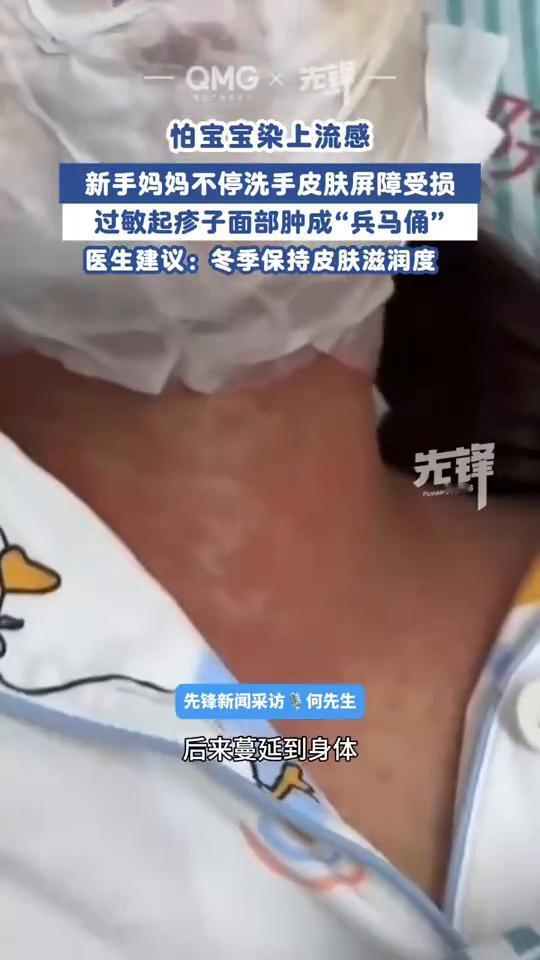 怕宝宝染上流感，新手妈妈不停洗手，皮肤屏障受损，过敏起疹子，面部肿成"兵马俑"。