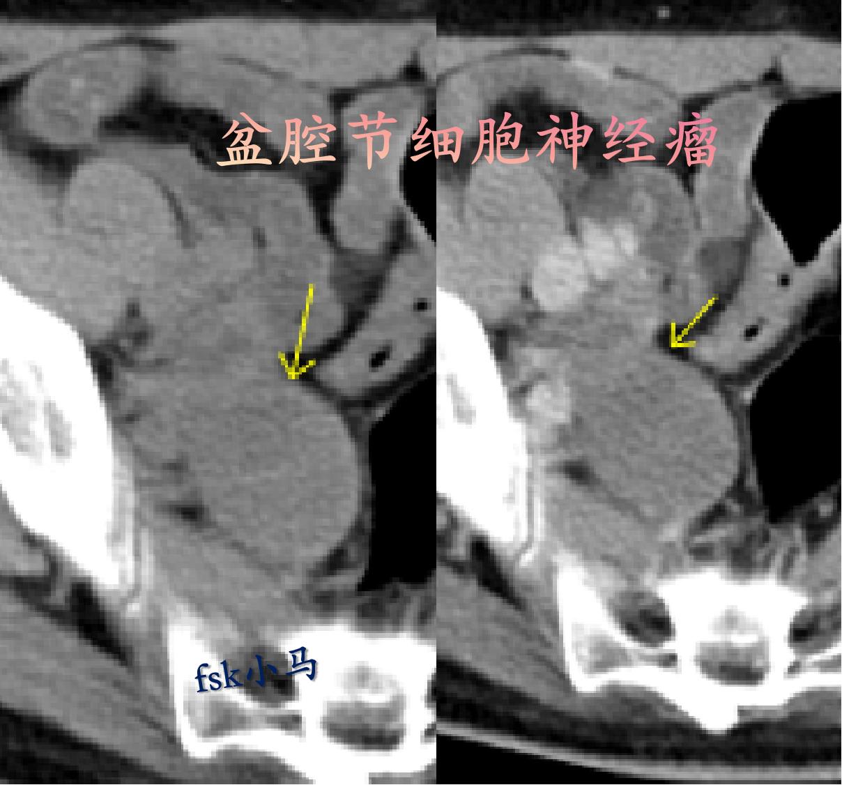 盆腔节细胞神经瘤