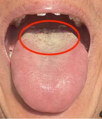 男人那方面，问题主要还是要看舌根！！！
 
我可不止一次说了，舌根是人体肾脏以及