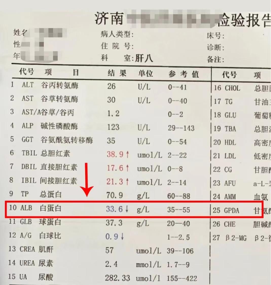 别拖！肝功能上这个数值低于30，警惕腹水！白蛋白是反映肝脏合成代谢功能各储备功能重要指标，也是诊断肝硬化及预后判断指标，是维持血浆渗透压的重要因素。
白蛋白降低可能与肝功能异常，肝脏合成蛋白质功能下降有关。白蛋白<30g/L部分病人出现或将要出现腹水，至25g/以下时预后不良，降至20g/L时预后极差。当出现白蛋白降低时我们需要及时就医，千万别拖着！