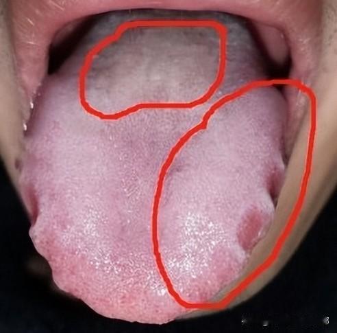 这么严重的齿痕舌，只祛湿已经晚了，参苓白术、六君子也是杯水车薪。

患者主诉：总