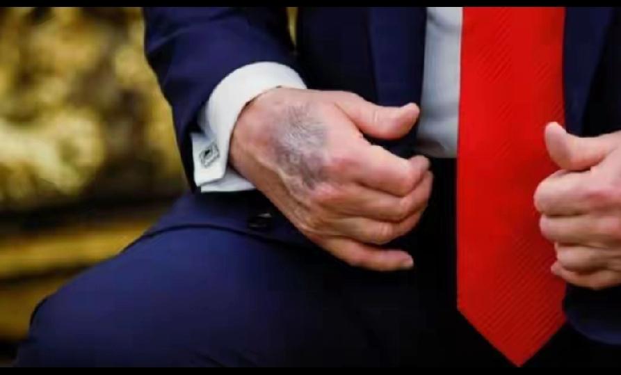 特朗普现在这药是真不能停！过去一年多他手上常出现淤青，一开始说是握手太用力，法国