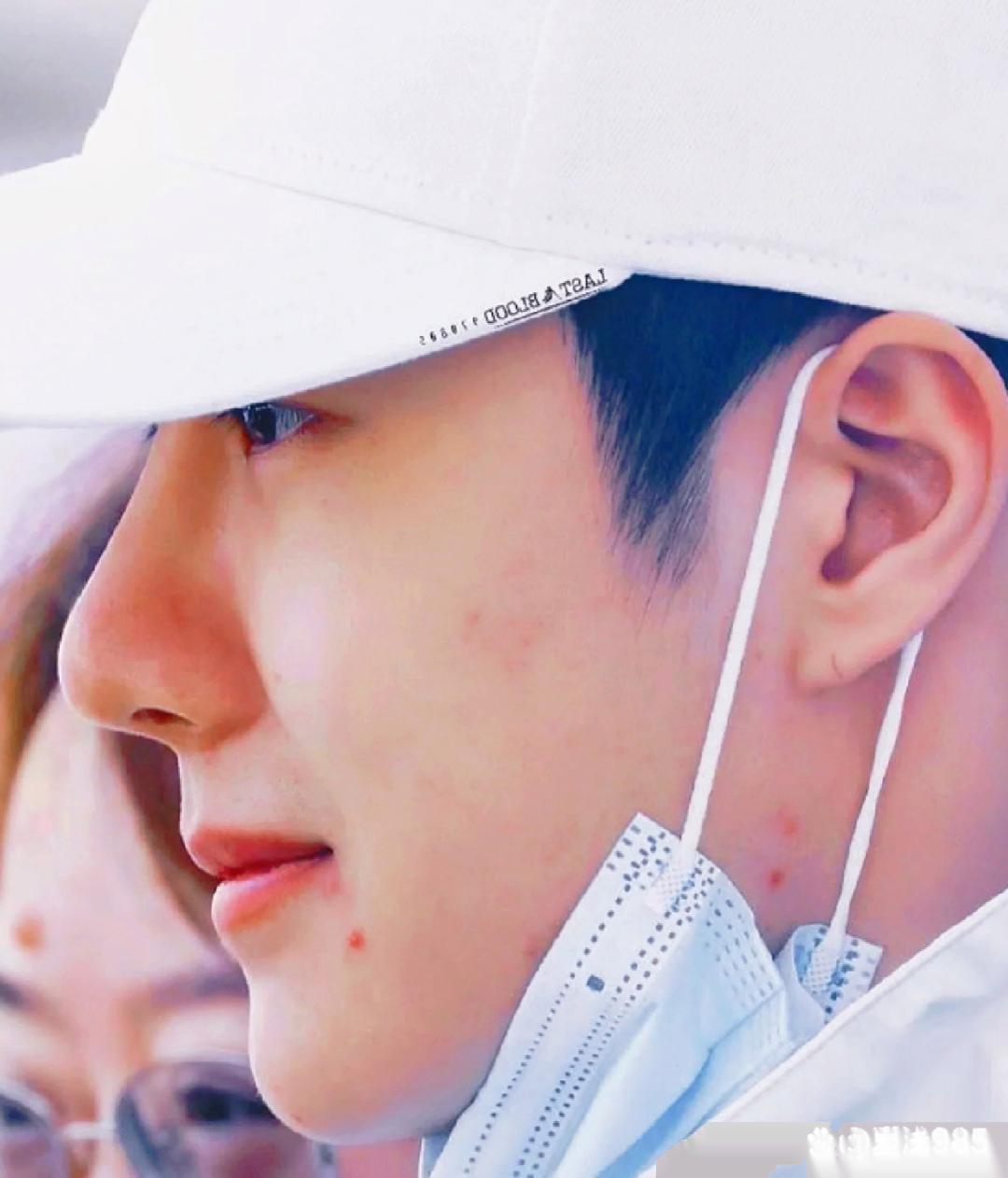 明星也有上火的时候啊 ​​​