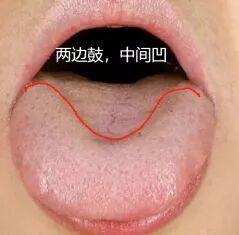 肝郁脾虚舌，你的参苓白术散都白吃了？！
各位朋友们，你们知道吗？有些看似脾胃不适