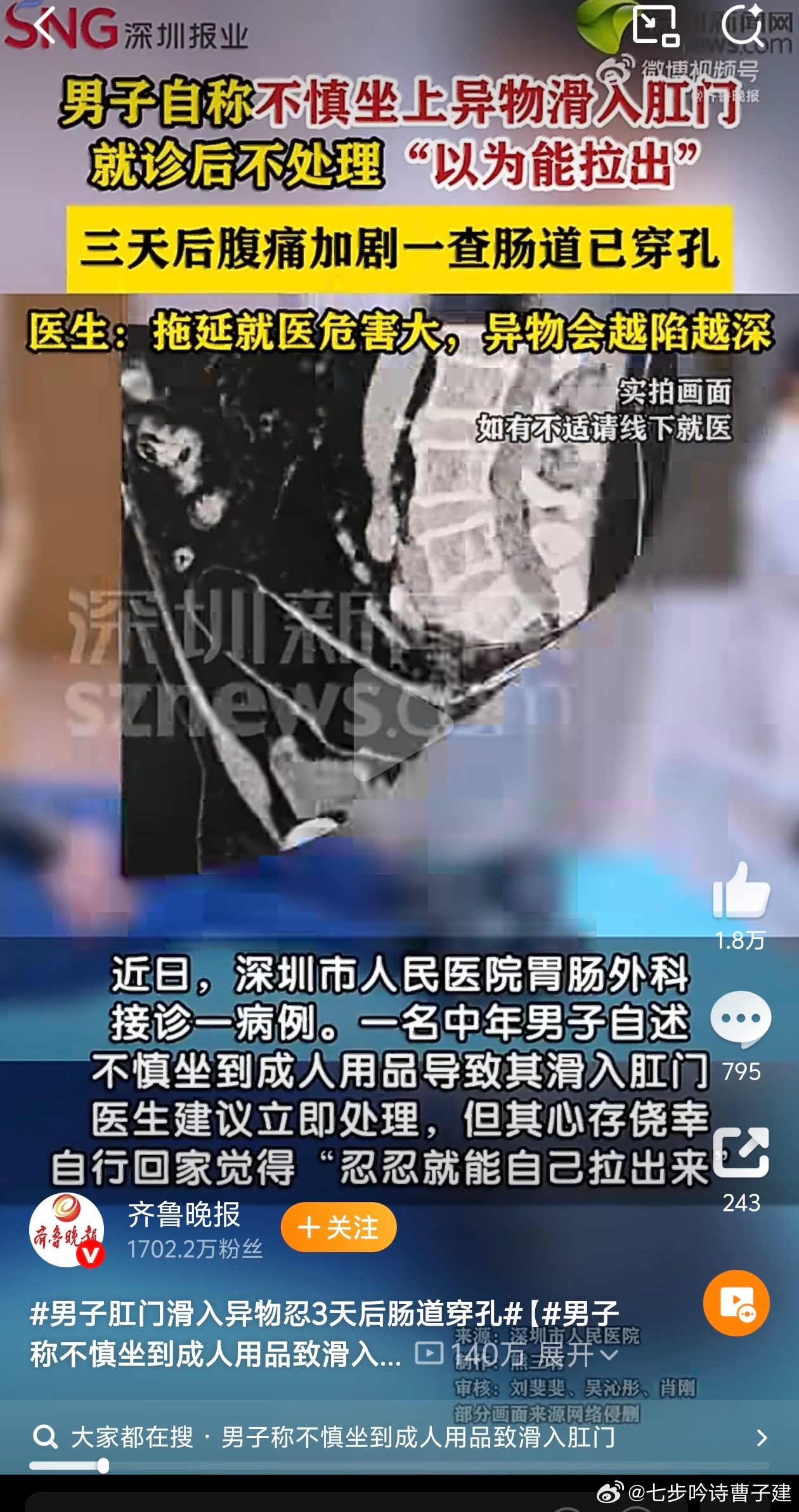 男子肛门滑入异物忍3天后肠道穿孔坐入了什么成人用品啊