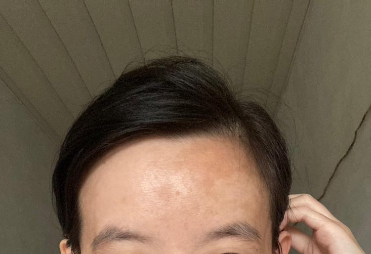 有通病网友告诉我额头的斑是真菌，我觉得也是。我得去上海治病。