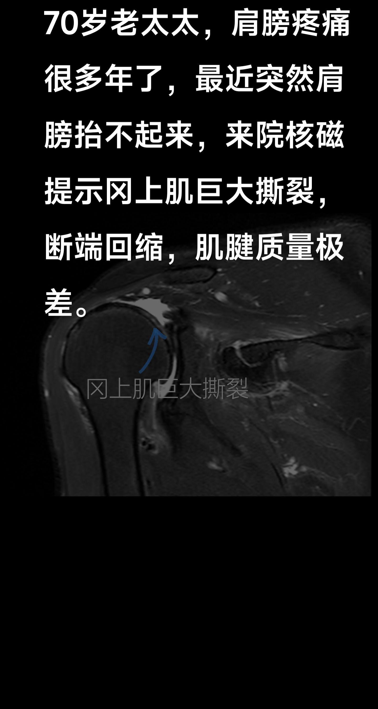 巨大肩袖撕裂。