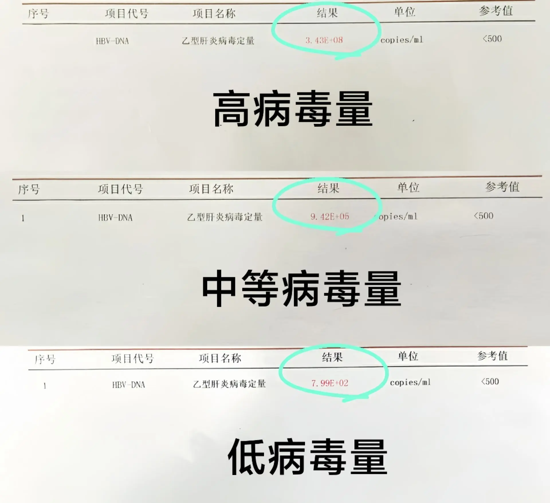 乙肝病毒载量如何去划分？ ①高病毒载量：大于10的6次方，这意味着血液...