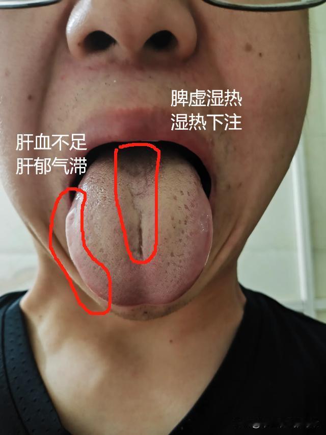 心肝火旺，脾肾亏虚，湿热下注，这3大男科劲敌
遇到一个都够呛，更别说，你这3项全