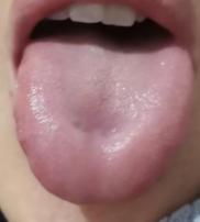 【舌诊分析】逍遥芄，柴胡舒肝芄均无用？中医：病情是在变化的！

患者症状：平时胸
