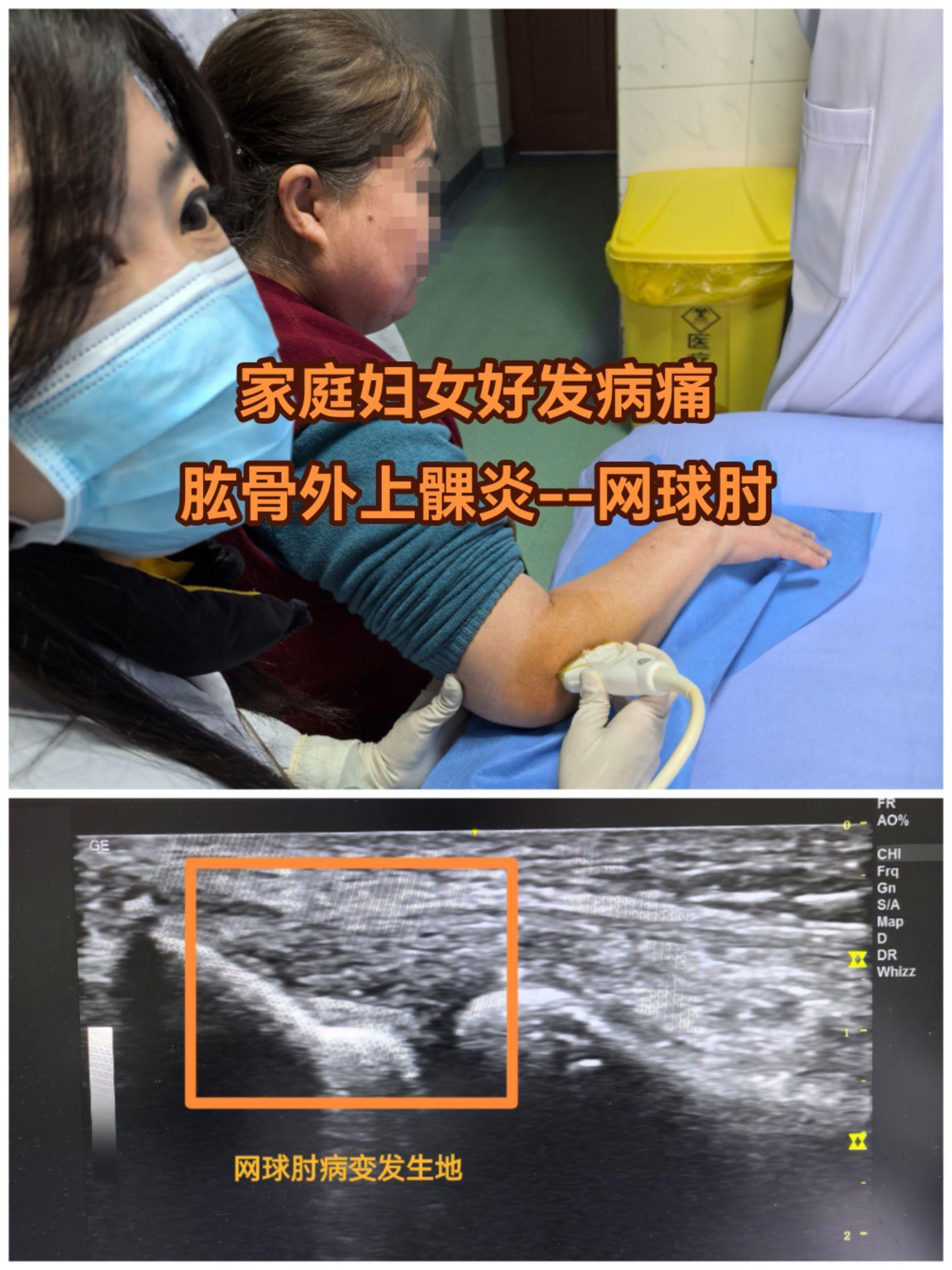 劳损性顽固肘关节外侧疼痛，请神容易送神难，既往认为好发于网球运动员，故...