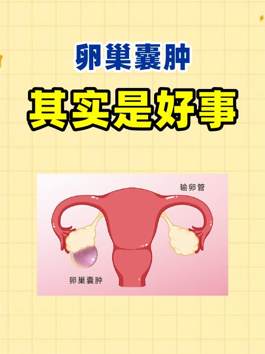 卵巢囊肿 其实是好事！