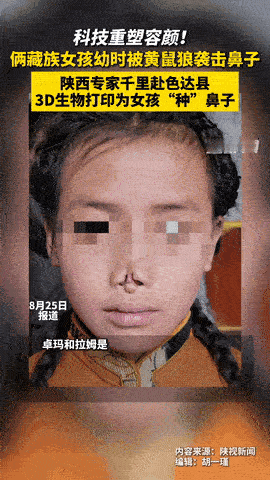 “这才是真专家！”四川甘孜，两名藏族女孩小时候睡觉时，意外被黄鼠狼咬下了鼻子，造