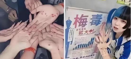 梅毒破万，救命药没了。2025年日本梅毒确诊病例超过13000例，连续第四年保持