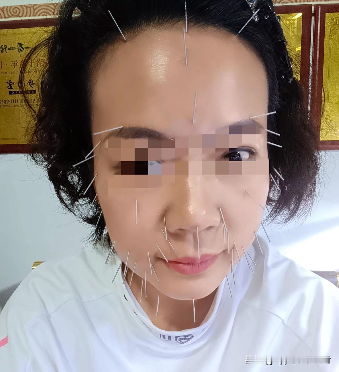 这些女子的承受力，也太强了吧！只见中医的大夫，把一根根银针麻利地扎在她们的脸上！