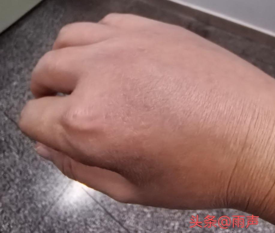 有什么土方法吗？右手中指和食指间不小心被蚂蚁还是虫子咬了一口！

现在整个手背肿