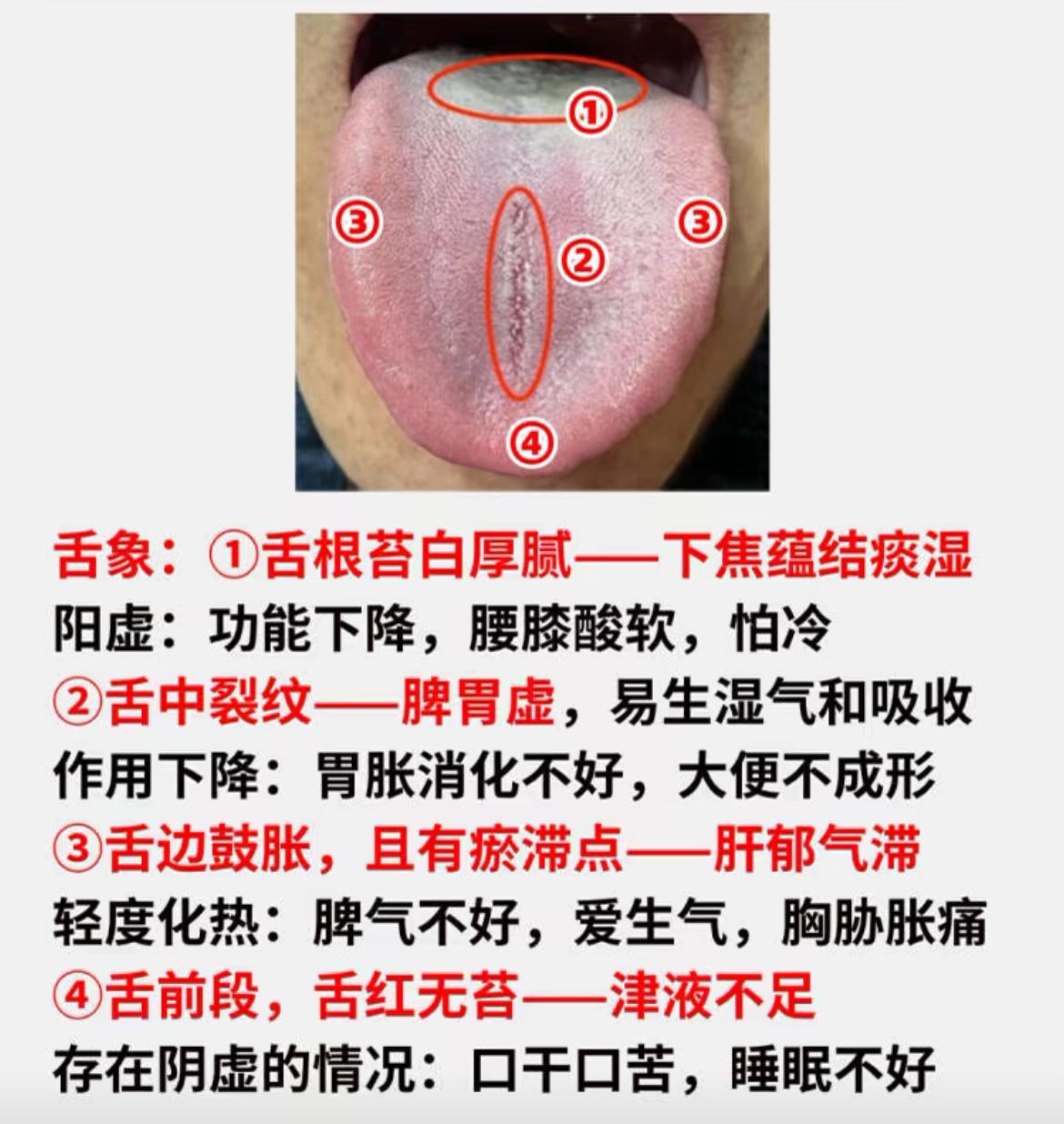 30岁的岁数，四五十岁的肾，你说你能行吗？[捂脸]

①舌根苔白厚腻——下焦蕴结