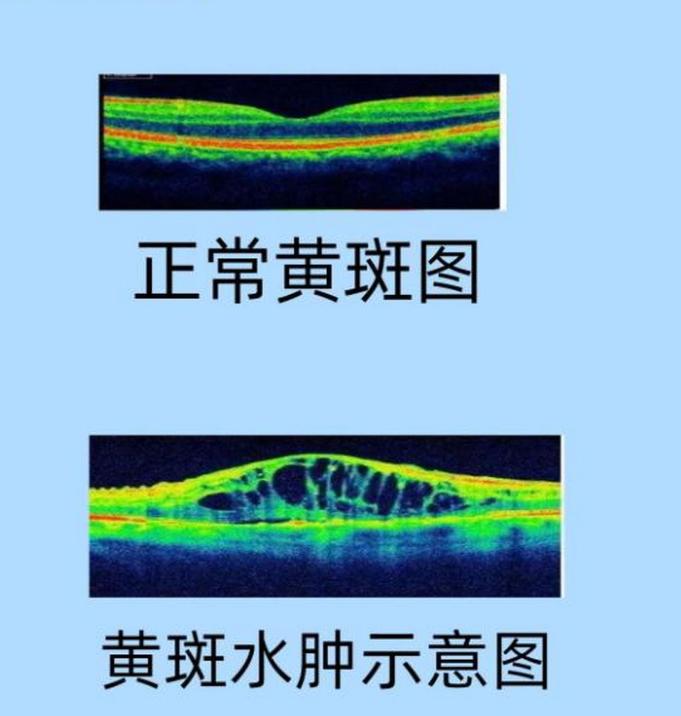 黄斑水肿会自行消失吗？黄斑“警报”如何解除？
黄斑区位于视网膜的后极部，是视觉最